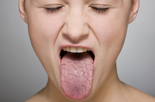 Bệnh Khô miệng: Nguyên nhân, biến chứng và cách điều trị